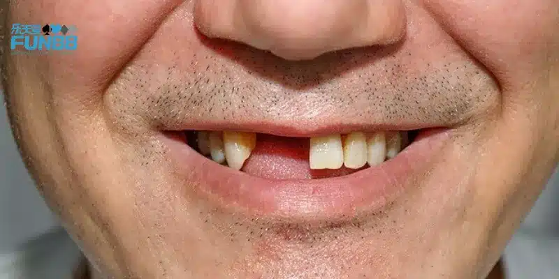 Mơ thấy rụng răng hàm dưới